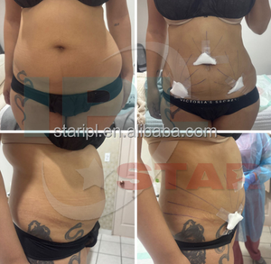 Neuestes Professionelles Optisches Faser-Endolaser-Gerät zur Hautstraffung und Gesichtslipolyse 1470nm Liposuktion-Lasergerät - Product Image 6