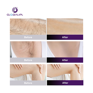 Máquina de Depilación Láser de Diodo de Cuatro Longitudes de Onda, Apta para Todo Tipo de Piel: 755/808/940/1064nm, Indolora y Permanente - Product Image 5