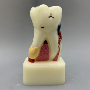 Модель стоматологической патологии кариес Пародонтит Демонстрация патологии полости рта Стоматологическое образование и обучение - Product Image 3