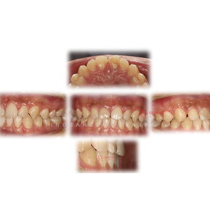 Carilla de cerámica de porcelana para dentaduras postizas de alta calidad, personalización privada para el cuidado <span class=keywords><strong>dental</strong></span>, recuperación oral - Product Image 4