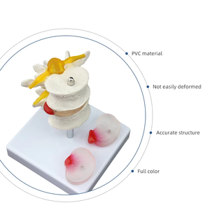Modèle de lésion de la colonne vertébrale lombaire FRT038 modèle de pathologie vertébrale à deux segments du disque lombaire enseignement des étudiants en médecine - Product Image 1