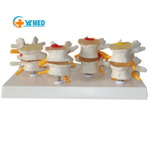 의학 과학 쇼케이스 인간 요추 디스크 탈출증의 4 단계 병변 실험실 연구 해부학 척추 모델 - Product Image 1