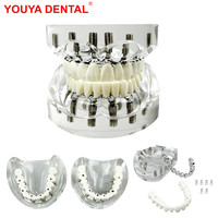 Modelo Anatómico de Implante Dental, 6 Implantes, Mandíbula Superior e Inferior, Restauración de Sobredentadura, Dientes Removibles, Educación, Estudio, Enseñanza