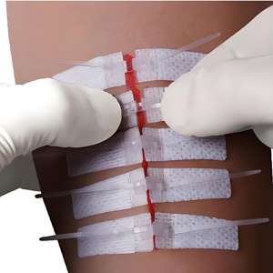 مجموعة إغلاق جروح طوارئ شفافة ضمادات فراشة وتضميد شريط خياطة للتمزق وشقوق - Product Image 5