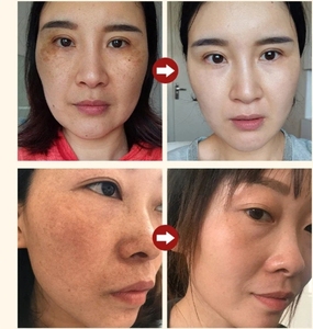 Nicotinamide sérum d'élimination des taches de rousseur <span class=keywords><strong>Anti</strong></span>-âge atténue les taches rétrécit les Pores du visage hydrate les produits de soins de la peau salicylique - Product Image 3