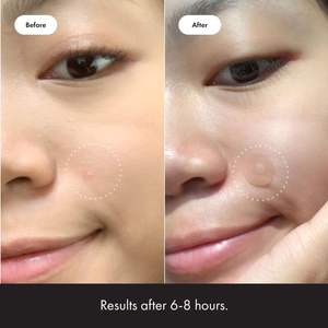 12 patchs hydrocolloïdes <span class=keywords><strong>pour</strong></span> <span class=keywords><strong>boutons</strong></span>, utilisés <span class=keywords><strong>pour</strong></span> couvrir l'acné et <span class=keywords><strong>les</strong></span> imperfections <span class=keywords><strong>sur</strong></span> <span class=keywords><strong>le</strong></span> <span class=keywords><strong>visage</strong></span> et la peau, <span class=keywords><strong>produit</strong></span> original - Product Image 5