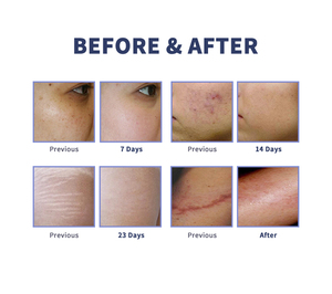 Eliminación efectiva de cicatrices Co2 Rejuvenecimiento láser facial Co2 Fraccional Láser Tubo de vidrio Láser vaginal <span class=keywords><strong>Precio</strong></span> - Product Image 6