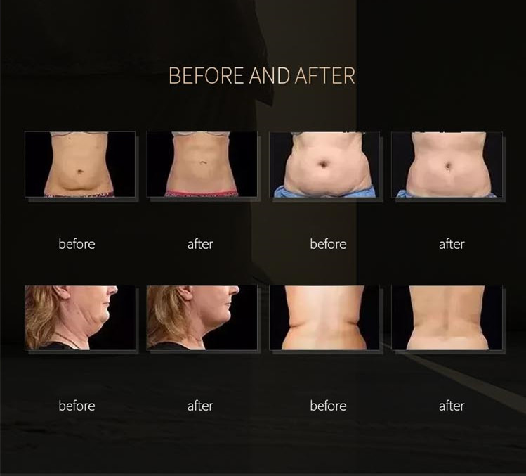 6 IN 1 lipolaser 650nm lipolaser vacuum cavitation rf/multifunction rf lipo laser beauty machine 7 in 1