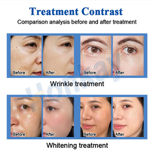 Máquina de rejuvenecimiento facial con oxígeno, máquina de hidrodermoabrasión con oxígeno para el cuidado facial. - Product Image 4