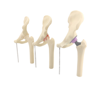 Modèle d'anatomie de l'articulation de la hanche, modèle de comparaison norme, arthrose et remplacement de la hanche, modèle pédagogique médical orthopédique, hauteur 240 mm