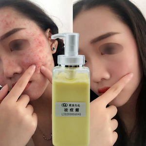 Crème hydratante biochimique anti-acné Ouquan, spécifications personnalisables pour le soin du visage des femmes et des hommes - Product Image 3