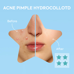 4 toppe colorate <span class=keywords><strong>Per</strong></span> scatola a forma di stella brufolo Patch con custodia in plastica con specchio - Product Image 5