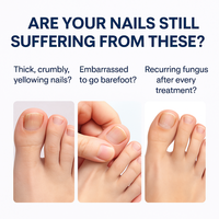 Soin antifongique et antibactérien pour les ongles à base de plantes, réparateur pour ongles gris, à l'acide undécylénique, liquide à absorption facile