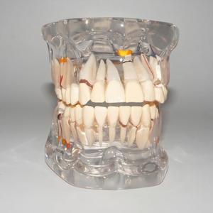 Modelo Dental Transparente <span class=keywords><strong>de</strong></span> Tamaño Real con Dientes Patológicos para Demostración en la Enseñanza Dental - Product Image 3
