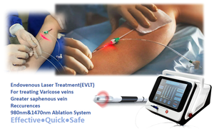 Láser <span class=keywords><strong>Endovenoso</strong></span> Médico de Doble Onda 980nm+1470nm para Ablación de Venas Varicosas Láser de Diodo Flebología EVLT Fibra Óptica Vascular - Product Image 2