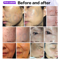 Appareil de plasma froid certifié CE pour le nettoyage de la peau, l'éclaircissement et l'atténuation des pores, stylo plasma professionnel.