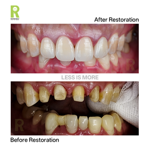 Rondcera Zirconia Block Versatile for <strong>Dental</strong> Lab Zirconia for Bridges High Quality <strong>Dental</strong> Zirconia Block for All Ceramic <strong>Crown</strong> - Product Image 6
