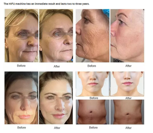 Appareil HIFU portable longue durée professionnel 7D pour lifting du visage, anti-âge, élimination des rides, amincissement corporel, avec <span class=keywords><strong>prix</strong></span> d'usine, nettoyage du visage - Product Image 6