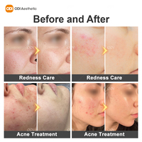 Dispositivo de Rejuvenecimiento Facial con Triple Frecuencia Real de 1 MHz, 3 MHz y 10 MHz para Tratamiento de la Piel, Enfriamiento Facial y Lifting Facial