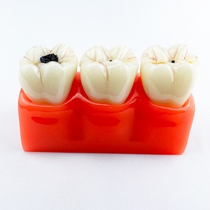 FUREIN SMILE Modelo Dental Patológico Desmontable 4 en 1, Anatomía del Diente con Caries, Educación Dental, Higiene Bucal Multiusos, PVC - Product Image 4