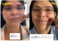 Équipement de liposuccion laser haute fréquence 980+1470nm Endo Fiber Lifting pour lifting du visage