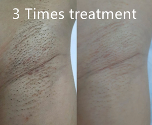 Thiết Bị Làm Đẹp Tẩy Lông Bằng <span class=keywords><strong>Laser</strong></span>/Tẩy Lông Bằng <span class=keywords><strong>Laser</strong></span> 755nm 808nm 1064nm <span class=keywords><strong>810nm</strong></span> Mới Nhất - Product Image 4