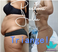 Laser à fibre diode 980 nm Lipo Lipolyse Élimination de la graisse Endo Laser Liposuccion Machine de beauté laser