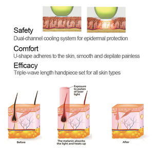 Machine d'épilation au laser à diode KES MED808 approuvée CE 3 longueurs d'onde 808nm 755 1064 - Product Image 4