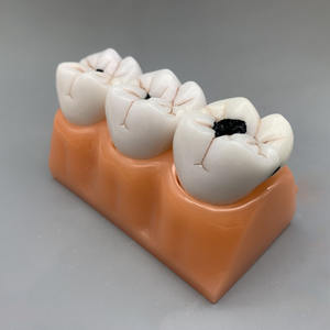 Modèle de classification de la carie dentaire quadruple Science médicale Maladie de la carie dentaire - Product Image 4