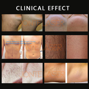 เครื่องกำจัดขนด้วยเลเซอร์ไดโอด 808 นาโนเมตร กำลังไฟ 1200 วัตต์ 1800 วัตต์ 3000 วัตต์ รุ่นใหม่ พร้อมระบบระบายความร้อนด้วยเซมิคอนดักเตอร์ สำหรับใช้งานเชิงพาณิชย์ - Product Image 3