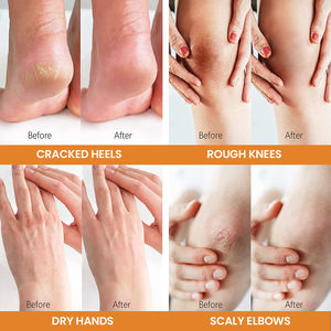 Gommage <span class=keywords><strong>pour</strong></span> <span class=keywords><strong>les</strong></span> <span class=keywords><strong>pieds</strong></span> à l'urée organique de haute qualité en gros <span class=keywords><strong>pour</strong></span> <span class=keywords><strong>les</strong></span> peaux rugueuses, épaisses, sèches, gercées et <span class=keywords><strong>les</strong></span> callosités - Product Image 5