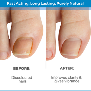 ETRUN ALISA Marque privée Anti-infection Paronychie Onychomycose Fongique Soins des <span class=keywords><strong>pieds</strong></span> Sérum Gel d'élimination des champignons des ongles Huile de récupération - Product Image 3