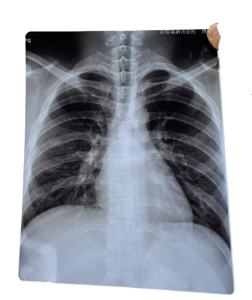 Groothandel Gratis Sample 10*12 Inch Op Maat Gemaakt Blauwe Inkjet Medische Film voor Röntgen, CT, CR, <span class=keywords><strong>DR</strong></span>, MTR, PET-CT, B-echografie - Product Image 1