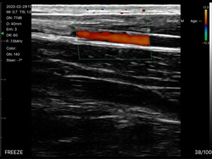 Sonde linéaire sans fil DMU37 à 128 éléments, la plus vendue, avec Doppler couleur pour MSK/Anesthésie/Vascularisation et Hôpitaux - Product Image 5