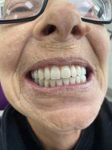 Zircone Zahn zirconia block consumabili dentali per laboratorio odontotecnico - Product Image 5