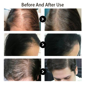 ZS Spa Elixir de croissance rapide des cheveux pour épaissir, lutter contre la chute et la fragilité des cheveux, traitement naturel à base de cellules souches EGF, sérum de repousse des cheveux - Product Image 2