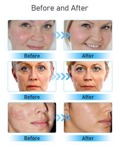 Chuyên nghiệp Microdermabrasion <span class=keywords><strong>Microcurrent</strong></span> chăm sóc da mặt Aqua Peel Hydro lời khuyên mềm Cleaner Hydra H2O2 Hydra dọc máy - Product Image 4