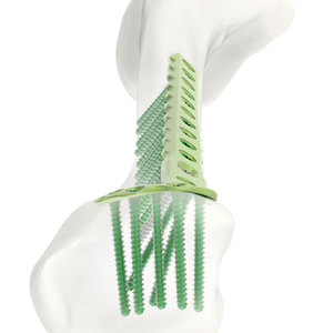 Placa de bloqueo pediátrica de alto rendimiento para implantes de fractura al por mayor, 5.0mm, para usar con tornillo cortical autorroscante de bloqueo 5.0 - Product Image 5