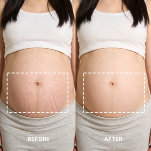 ホット販売シリコン製アンチエイジングパッド、再利用可能、洗濯可能、透明シリコンベリーパッチ、妊婦のストレッチマーク用 - Product Image 2