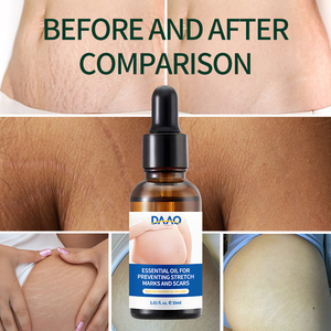 Căng Tự Nhiên Đánh Dấu Cơ Thể Dầu Cho Phụ Nữ Sau Sinh Chăm Sóc Da Sửa Chữa Da Và Cải Thiện Độ Đàn Hồi Da - Product Image 6