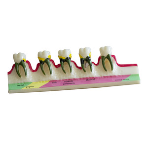 Modelo Anatómico de Caries Dental de Resina, Modelo de Exhibición de Decadencia Dental con Sellador de Fisuras, Modelo de Clasificación Periodontal - Product Image 2