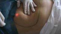 980nm Diodo Láser Liposucción facial Cirugía plástica Lipólisis Estiramiento facial Forma del cuerpo Dispositivo de cánulas de fibra