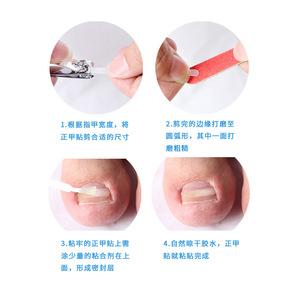 In-stock ingrown toenail correction <b>kit</b>, including <b>nail</b> grafts, <b>nail</b> groove pliers, and <b>nail</b> wires for correcting toenails. - Product Image 4
