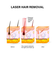 2025 Huamei Haute Intensité Laser 808nm Diode Laser Épilation Machine Prix 755 808 1064 Nm pour Salon De Beauté
