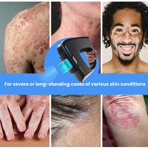 Láser Excimer de Alta Calidad Kernel CE, Láser Excimer de 308 nm para el Tratamiento del Vitiligo - Product Image 4