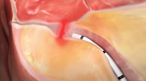 Private Label 980 1470nm Soins de santé Saignement Hémorroïdes Brûlant Gonflement Douleur <span class=keywords><strong>Anus</strong></span> Traitement Soulagement Douleur Hémorroïdes Pommade - Product Image 2