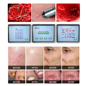 New Arrival Diode <strong>Laser</strong> 980 nm Spider Vein Removal Blood Vessels Removal Fungus Nail Fungus <strong>Treatment</strong> Machine for Beauty Salon - Product Image 4