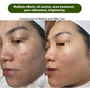 Poudre et sérum de <span class=keywords><strong>micro</strong></span>-aiguilles bio à base d'éponge d'algues Spongilla pour le peeling, la régénération cutanée, l'élimination des cicatrices d'acné et de la mélanine - Product Image 2