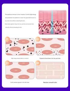 Apparecchiatura Laser Picosecondo a Tripla Lunghezza d'Onda, Rimozione Non Invasiva di Tatuaggi e Pigmenti Sopracciglia con Energia Regolabile - Product Image 3