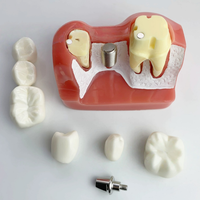 Modèle de démonstration d'implant dentaire Premium 4X avec couronne et pont amovibles pour cliniques et écoles dentaires